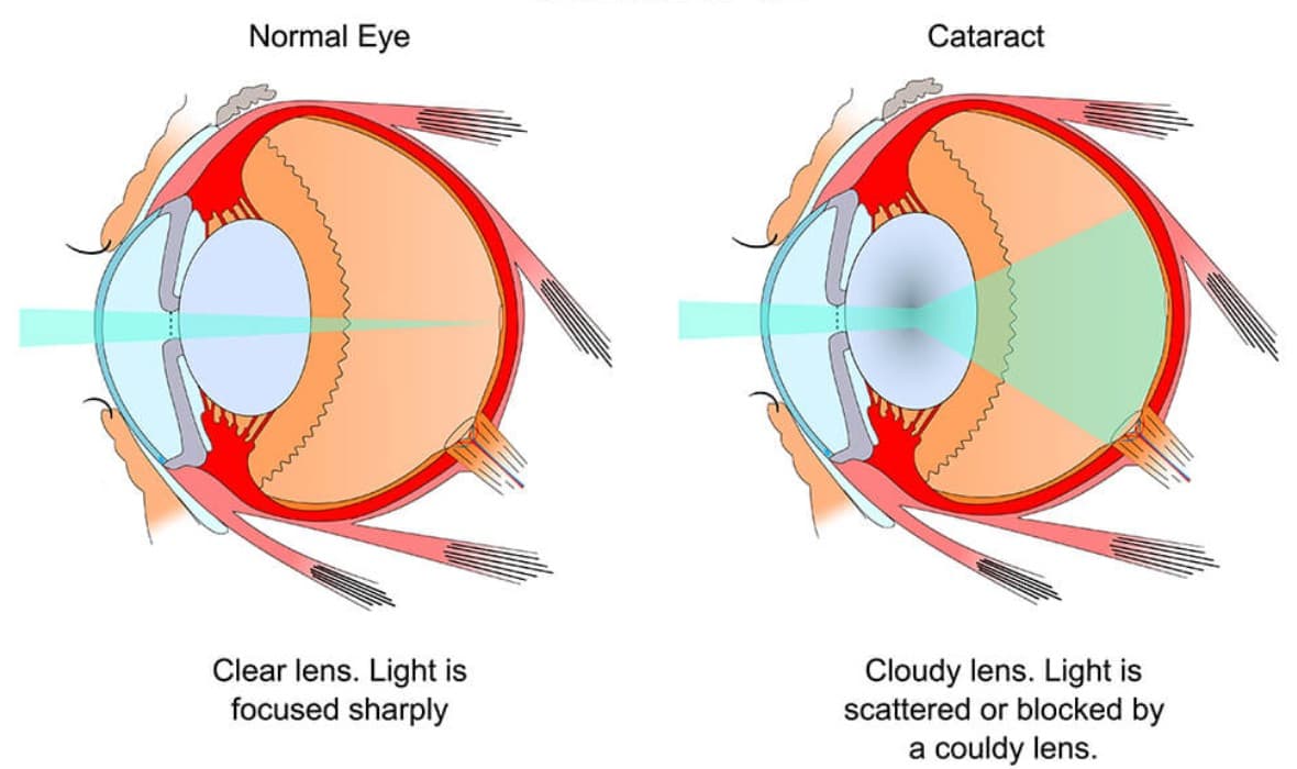 Cataract Surgeries in Sub-Saharan Africa
